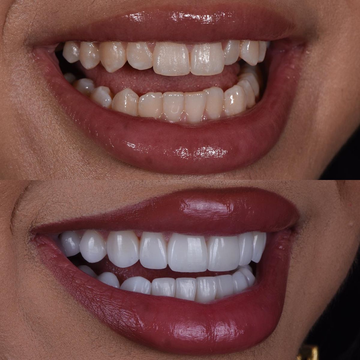 Résultat orthodontie avant-après — Dr Tahri Rabat Agdal