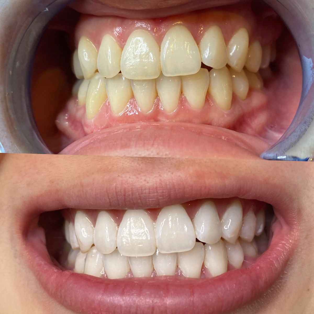 Transformation sourire esthétique — cabinet Dr Tahri Rabat