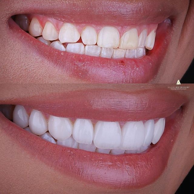 Transformation sourire avant-après — Dr Tahri Agdal