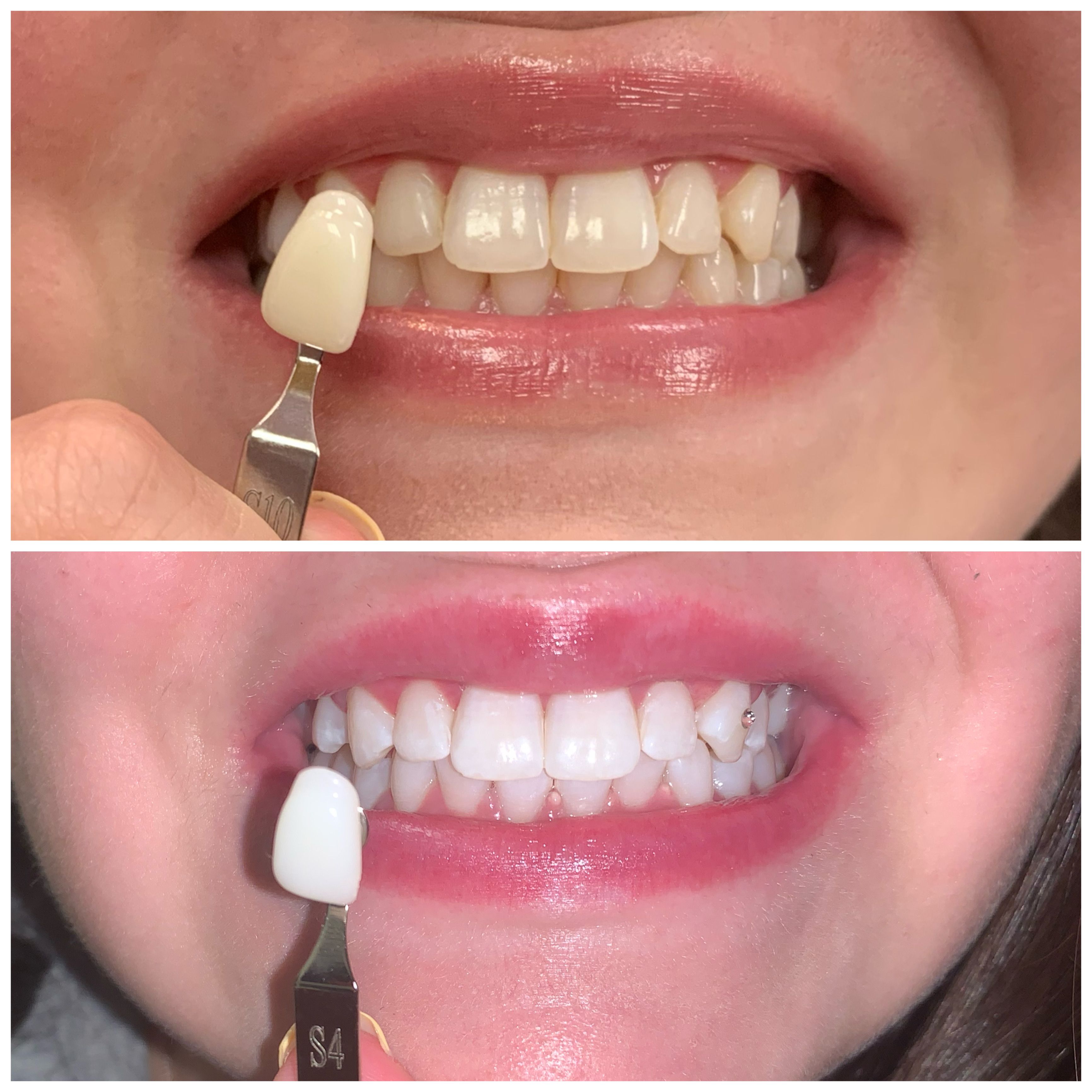 Traitement orthodontique bagues — Dr Tahri Rabat Agdal